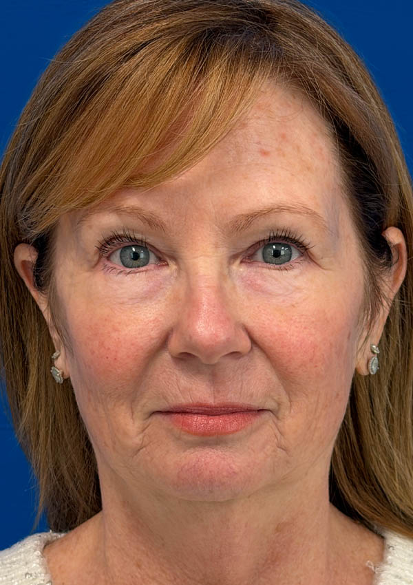 1_0001_RA AP Pre.png