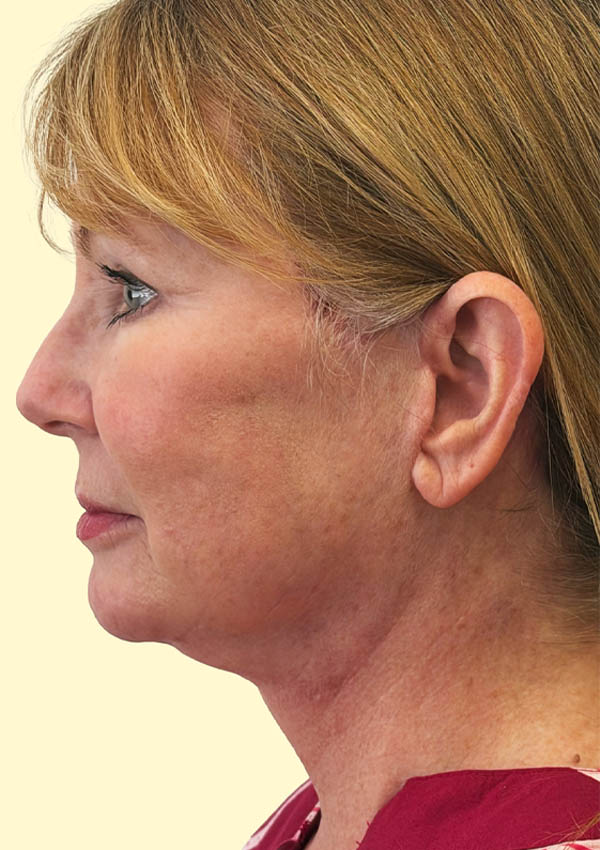 1_0002_RA Lateral Post.png