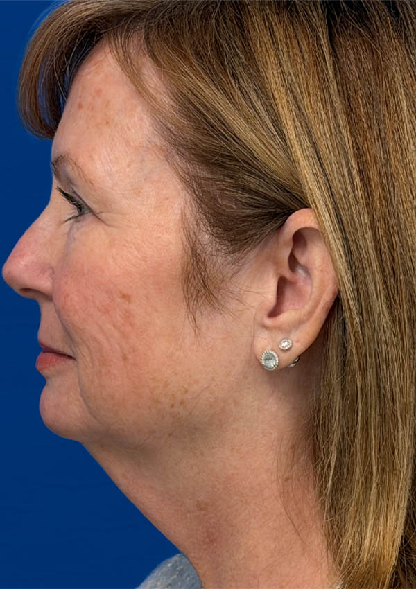 1_0003_RA Lateral Pre.png